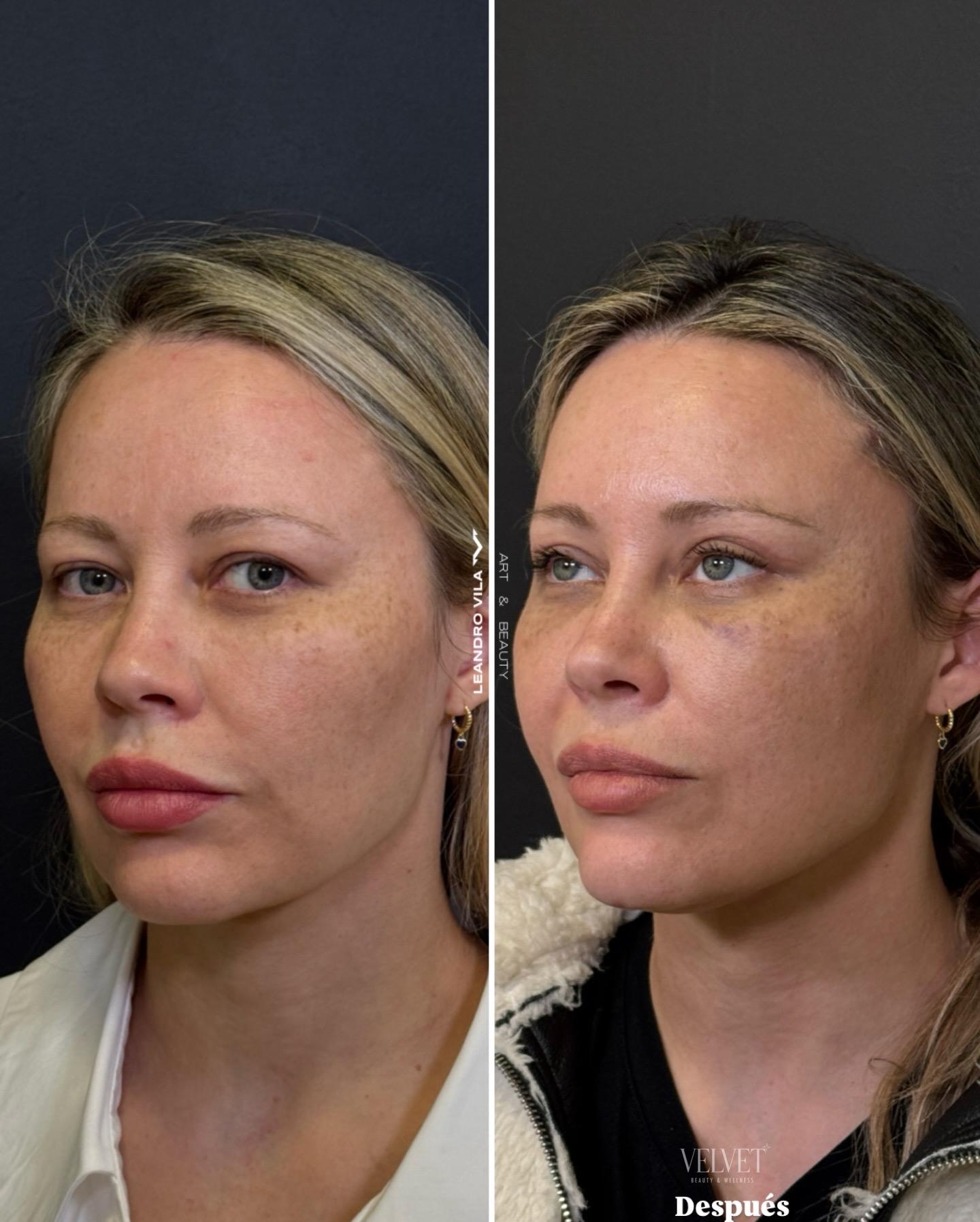 Anatomía y planos profundos del Deep Plane Facelift - Dr. Leandro Vila Buenos Aires