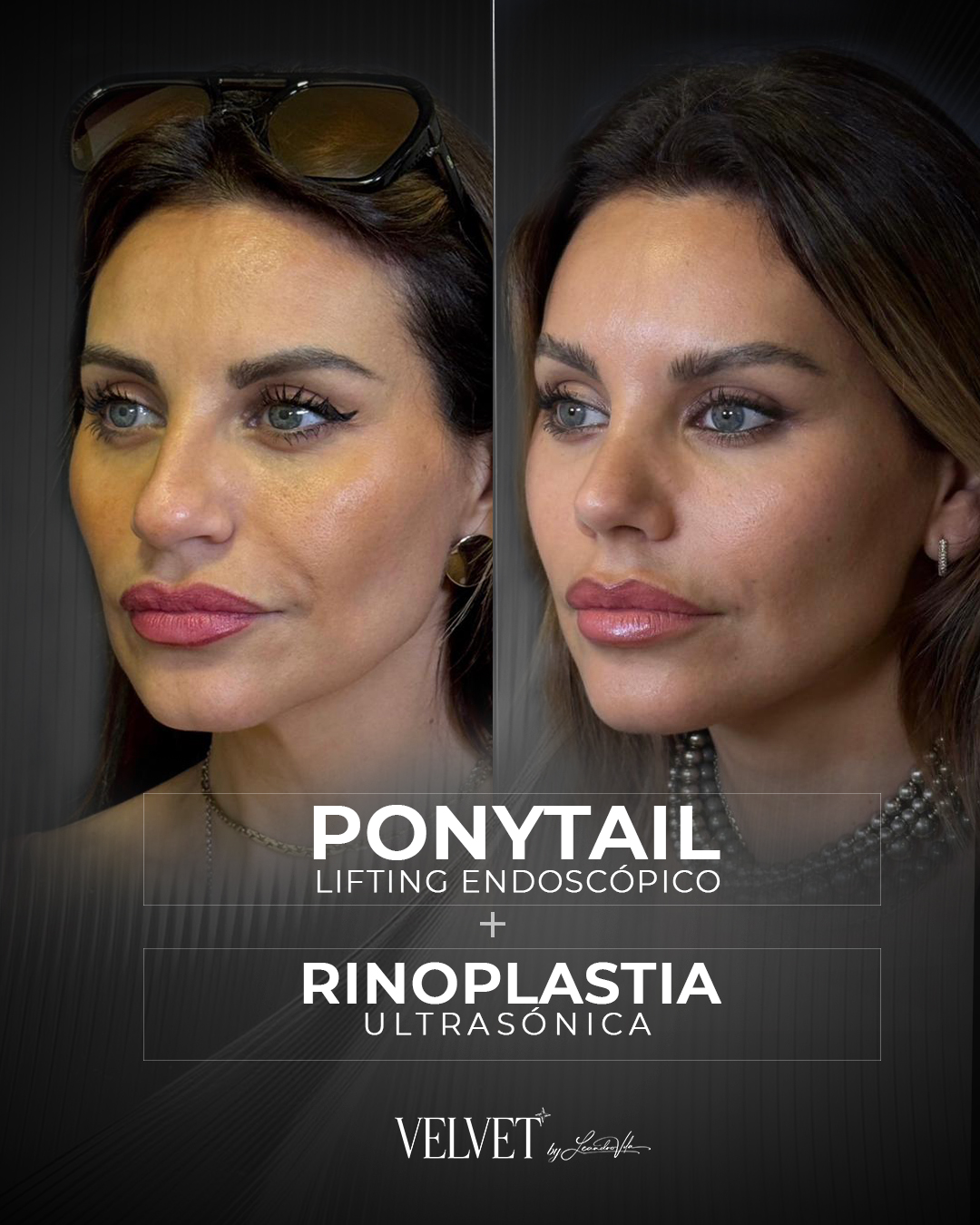 Antes y Después - Ponytail Lifting Endoscópico y Rinoplastia Ultrasónica
